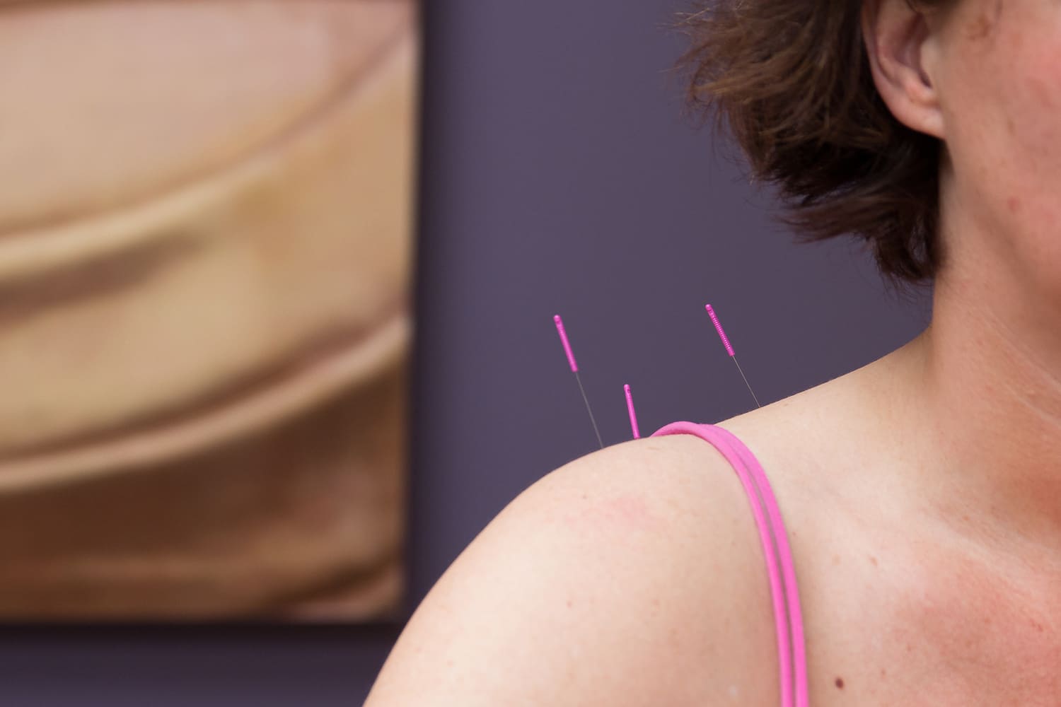 Acupunctuurnaalden in schouder voor therapie bij Manuele Therapie Prinsenbeek, tegen een lichtpaarse achtergrond.