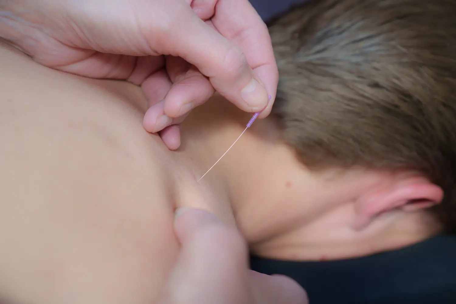 Naald ingebracht tijdens acupunctuurbehandeling bij Manuele Therapie Prinsenbeek.